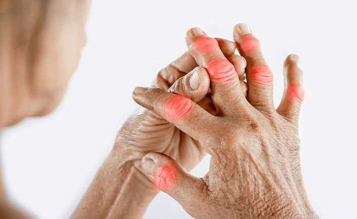 Arthritis Management